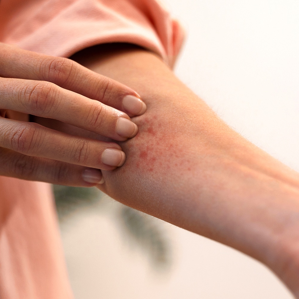 Common Allergic Reactions From Household Pests in Central Coast NSW